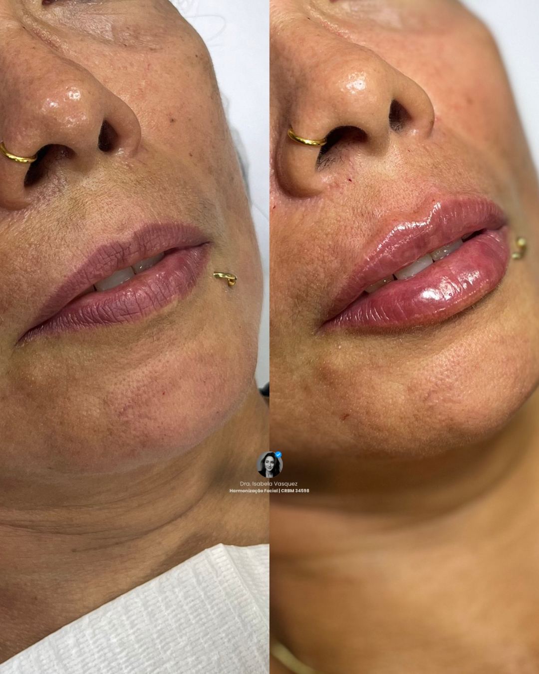 Antes e depois de preenchimento labial