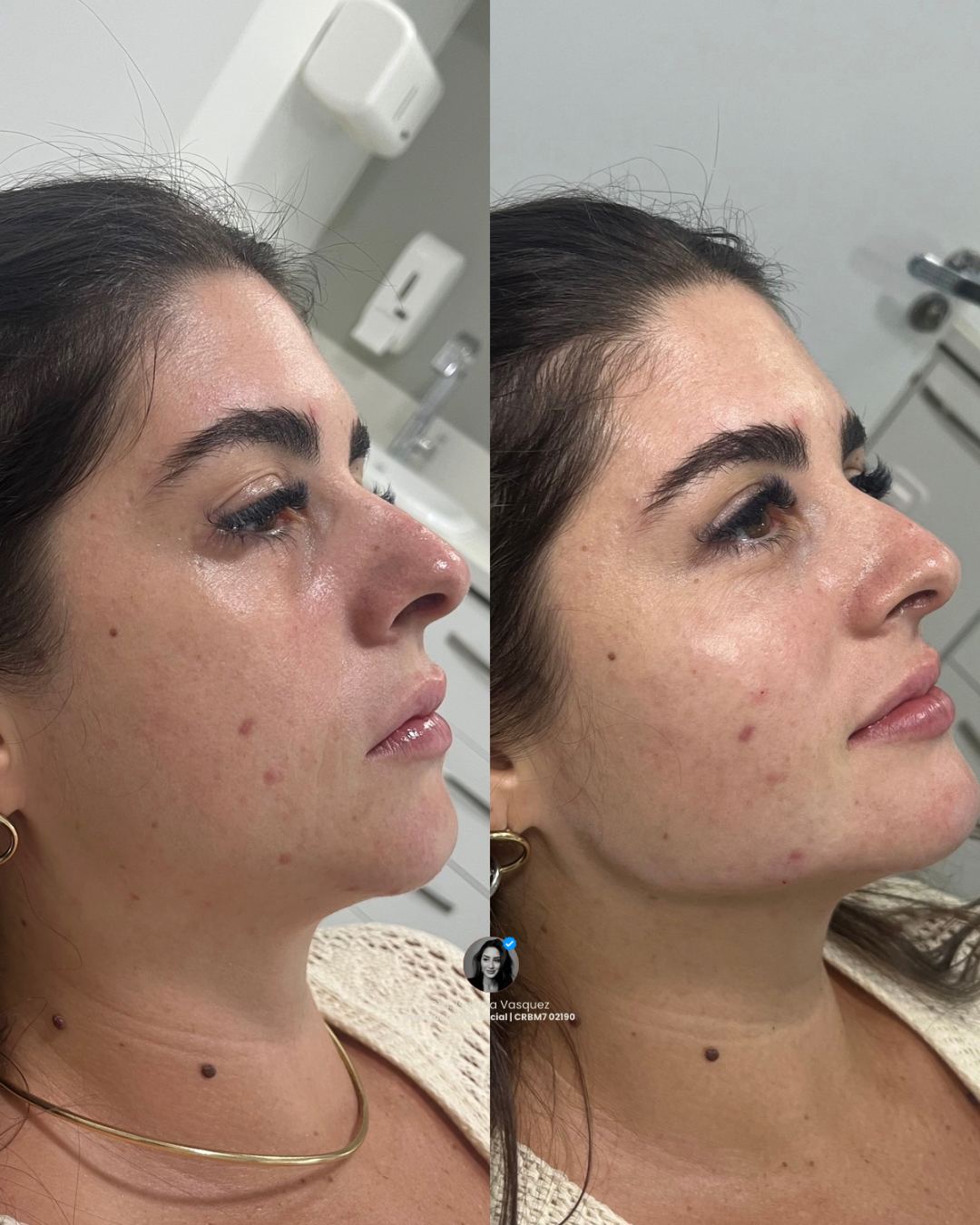 Antes e depois de harmonização facial