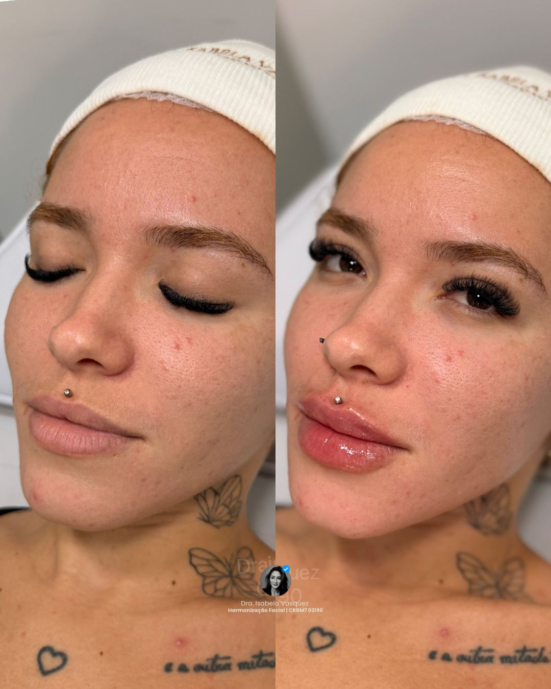 Antes e depois de harmonização de perfil