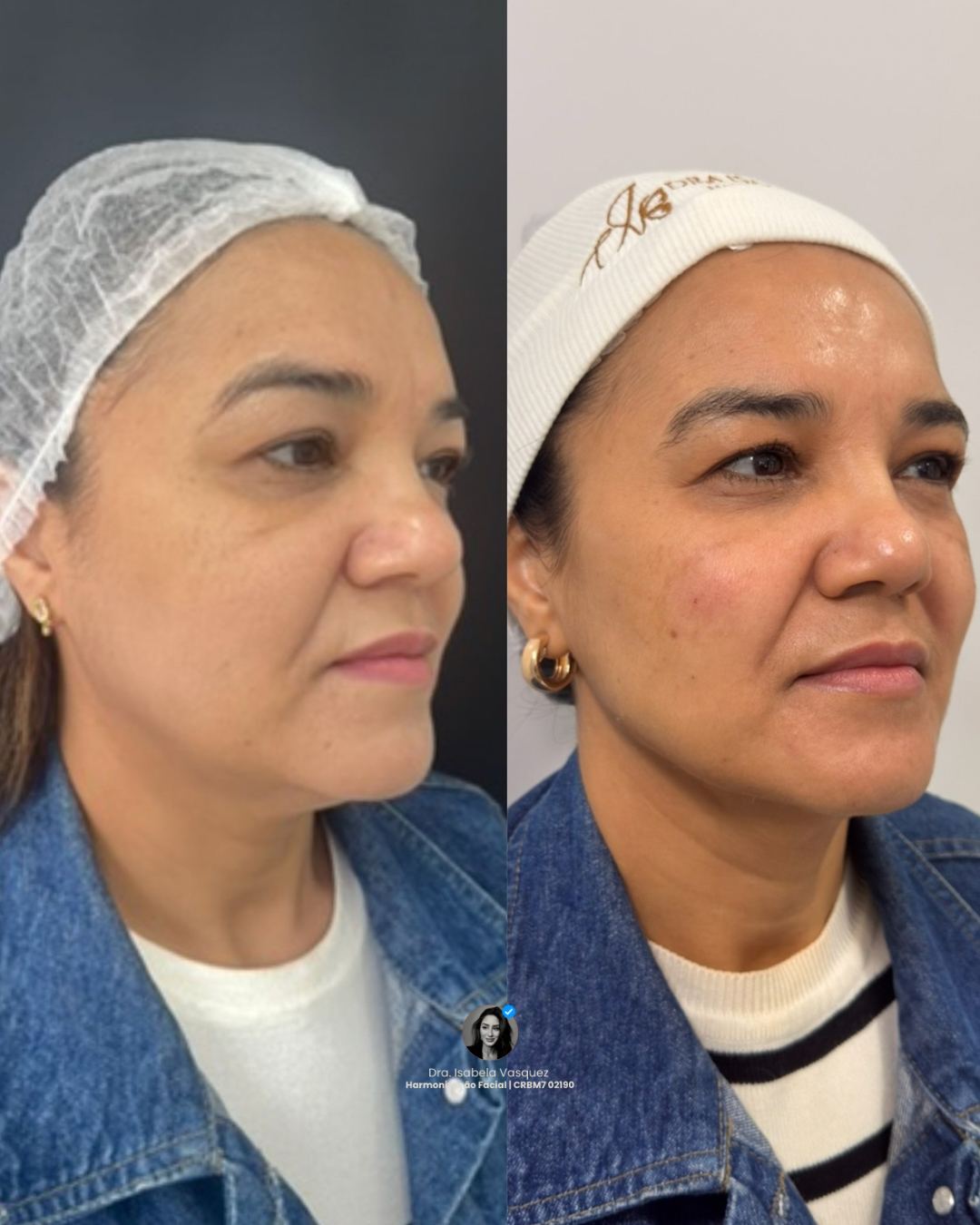 Antes e depois de rejuvenescimento facial